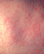 Image of measles infection