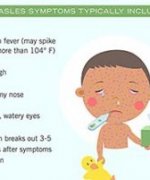 Infographic. Measles symptoms typically include...