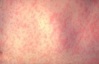Measles virus signs and symptoms
