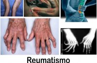 Reumatismo e causado por virus ou bacteria