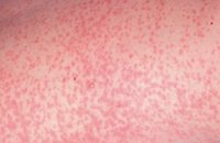 Rubella virus signs and symptoms